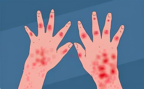 银屑病患者皮肤上出现红肿现象是什么原因导致的